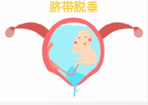 孕婦臍帶先露！阜陽市婦女兒童醫(yī)院婦產(chǎn)急救中心爭分奪秒，護(hù)佑母嬰安全！