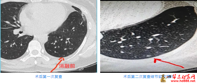 被“凍死”的結(jié)節(jié)：低溫冷凍，高效消瘤，肺結(jié)節(jié)患者健康的新選擇！